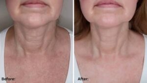 Can Red Light Therapy Tighten Loose Neck Skin? What to Expect