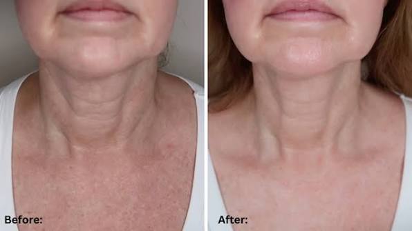 Can Red Light Therapy Tighten Loose Neck Skin? What to Expect